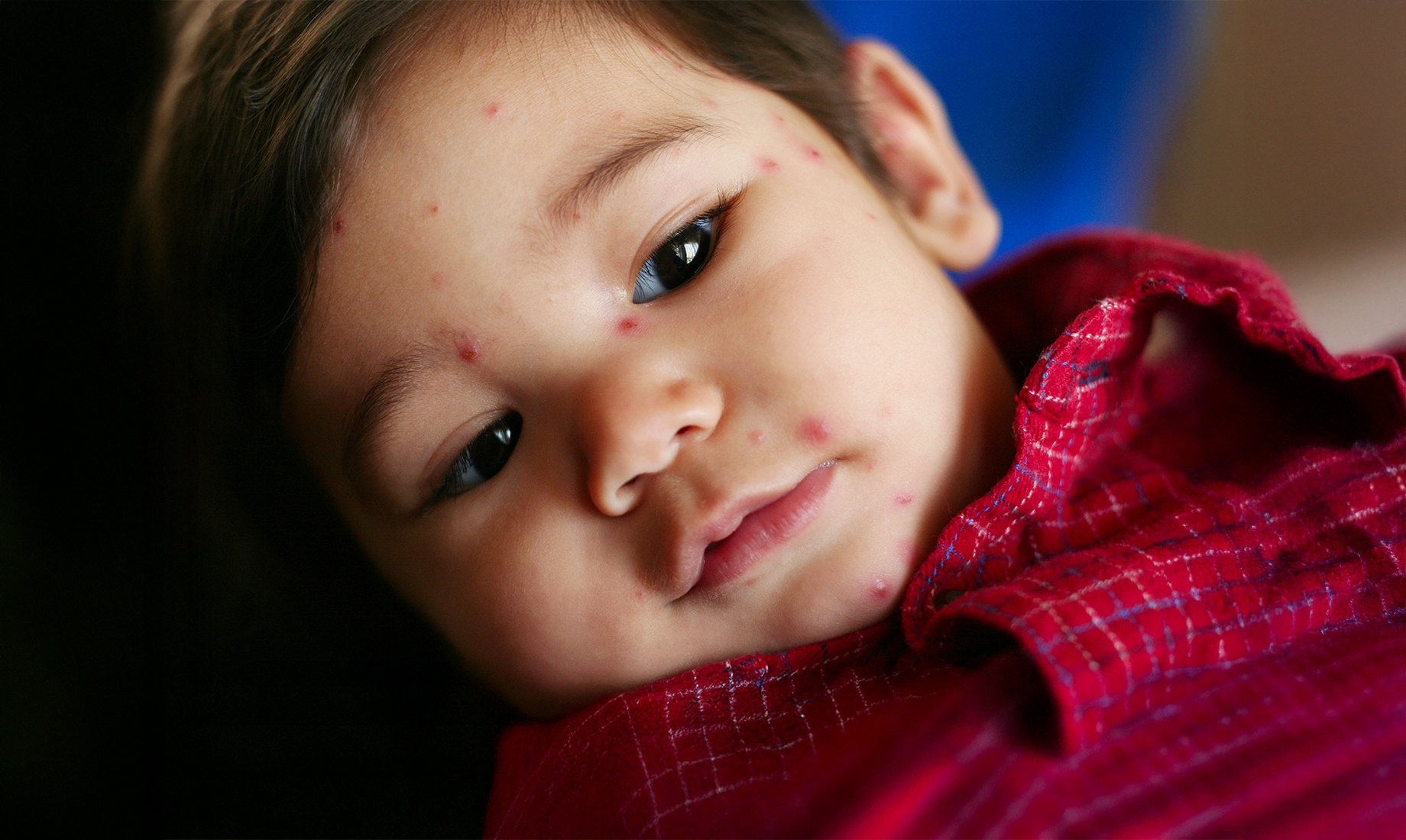 Closeup of a young boy with chickenpox.
