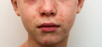 Closeup of a young boy with measles.
