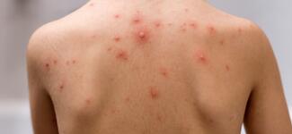 Closeup of a young boy's back with chickenpox.